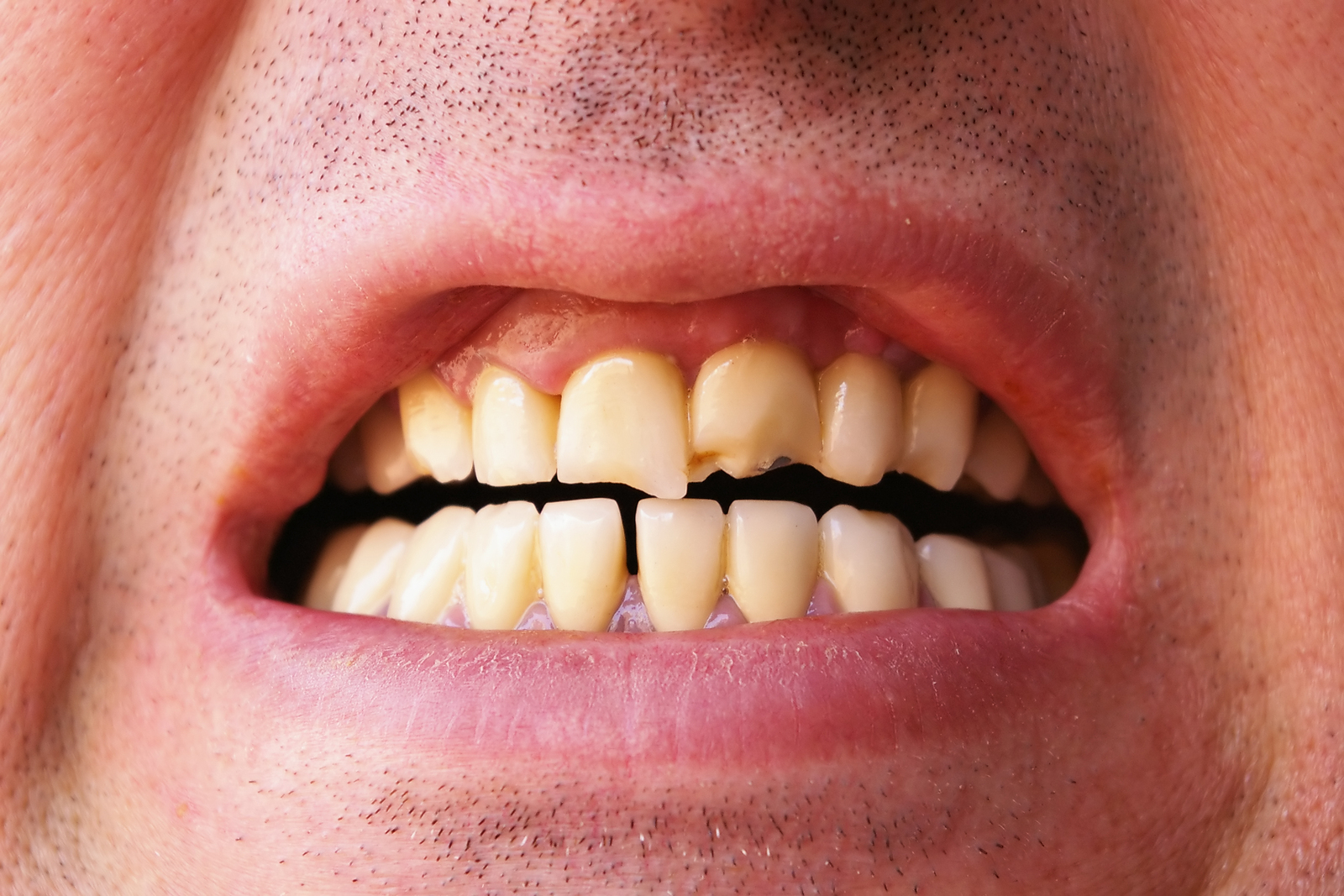 Chipped Tooth | Dentist InFarmington Hills, MI | Pure Dental 
