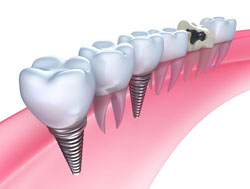 Dental Implants Farmington Hills and Sterling Heights MI